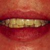 審美義歯は、全ての面でインプラントを超える入れ歯です！