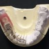 快適な入れ歯生活を満喫するための歯医者選び