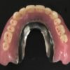 理想的な人工臓器としての入れ歯、金属二重構造義歯