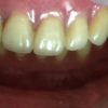 入れ歯安定剤を使わなくてもよい入れ歯はあるのですか？ あります。それを吸着義歯と言います。